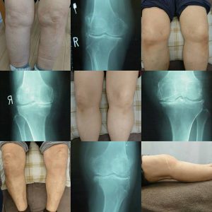 変形性膝関節症のコラージュ