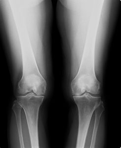 変形性膝関節症のレントゲン画像