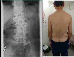 脊柱の変性（腰痛）