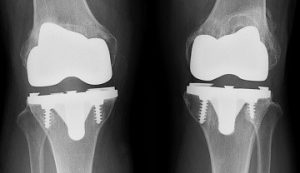 人工膝関節置換術後のレントゲン画像