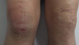 人工膝関節置換術後の外観