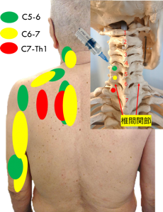 椎間関節ブロックと関連痛
