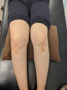 変形性膝関節症の外観