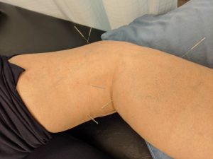 膝の鍼施術