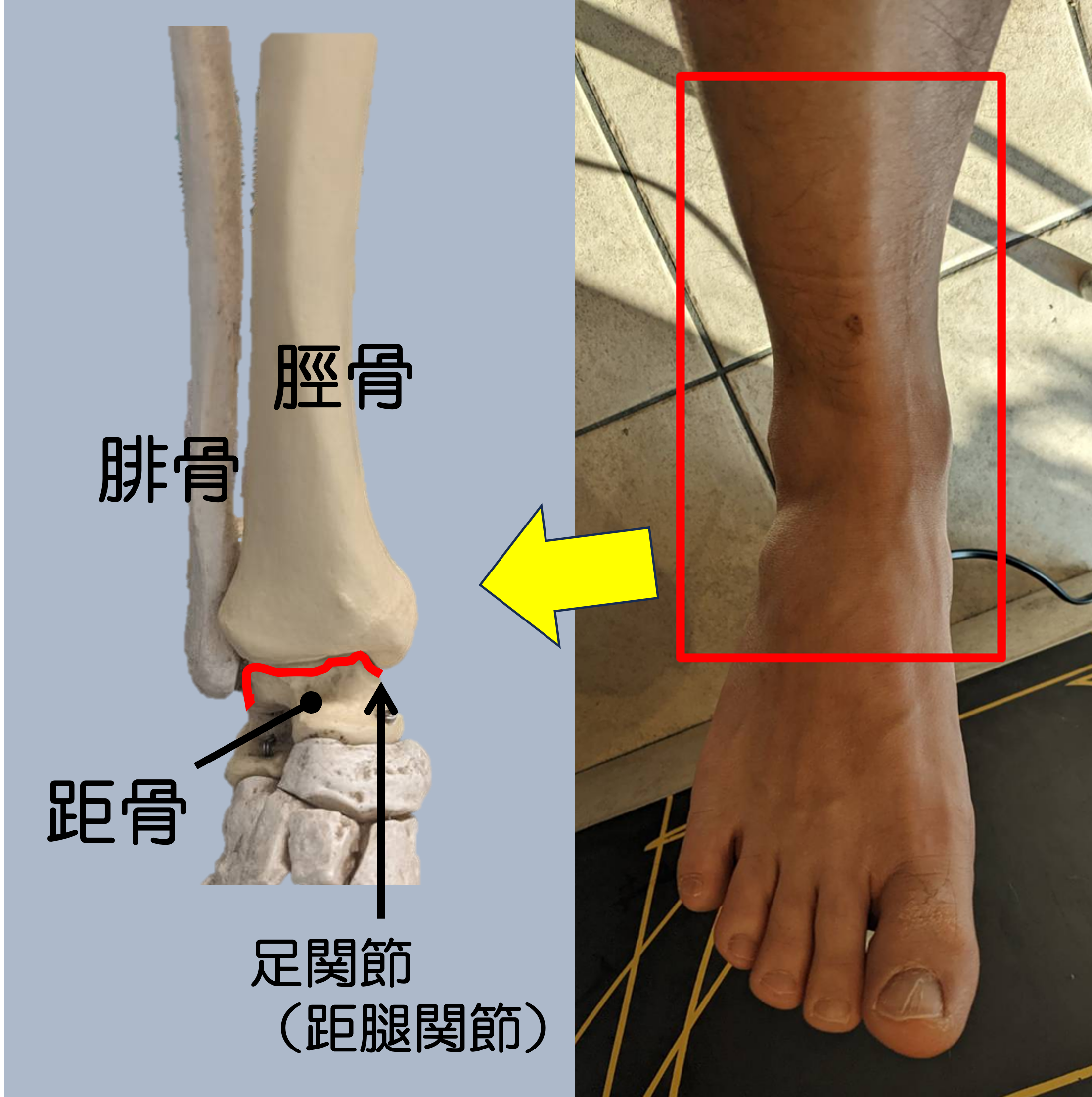 変形 性 足 関節 症