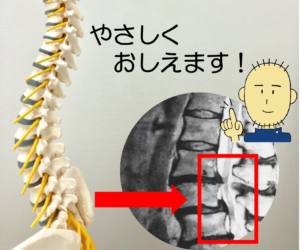 腰部脊柱管狭窄症の解説