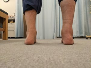 変形性足関節症（外傷後）
