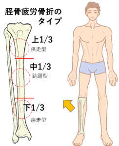 脛骨疲労骨折のタイプ