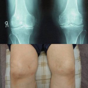 変形性膝関節症の外観とレントゲン