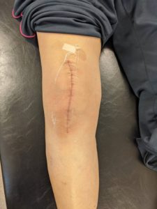 手術後の膝の痛みイメージ