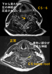 頚椎椎間板ヘルニアMRI冠状面