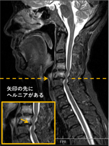 頚椎椎間板ヘルニア矢状面MRI
