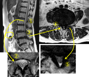 腰部脊柱管狭窄症のMRI