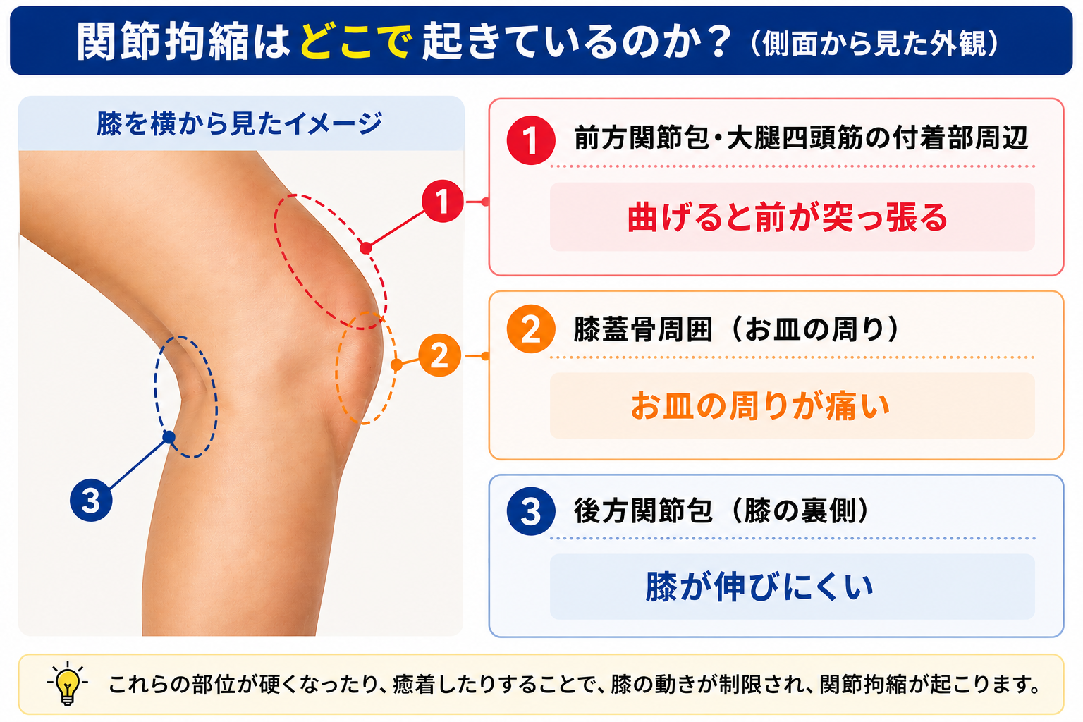 膝蓋骨 骨折 つっぱり 感