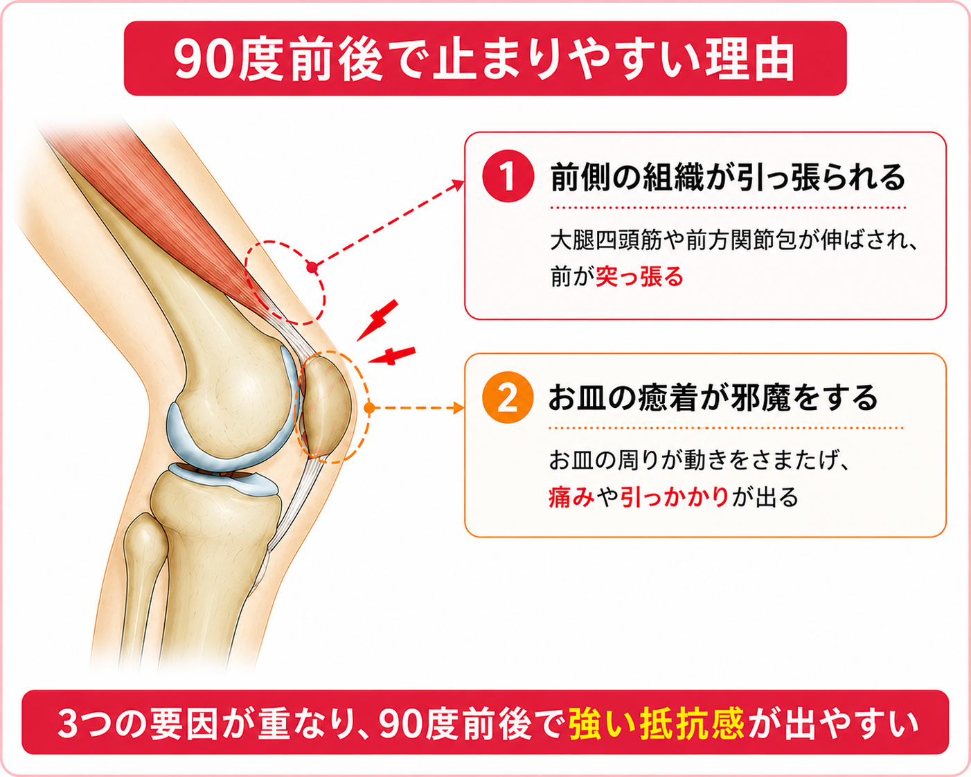膝蓋骨 骨折 つっぱり 感
