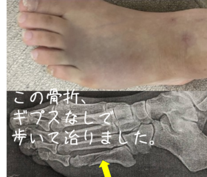 第５中足骨骨折のレントゲンと外観　小川鍼灸整骨院