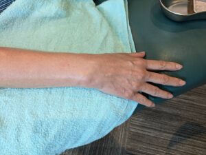 CRPS type1